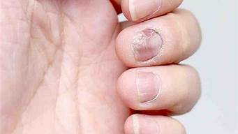 灰指甲会发展成癌吗(灰指甲会影响寿命吗)