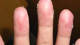 手指脱皮是什么原因造成(手指最近脱皮严重是什么原因)