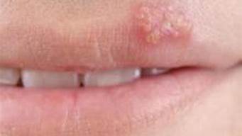 嘴唇疱疹过后为什么刺痛肿胀「疱疹快好了为啥嘴巴还是肿的」