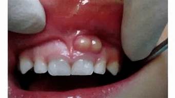 牙龈能长口腔溃疡吗(牙龈会有口腔溃疡吗)