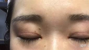 双眼皮有疤痕如何修复(双眼皮有疤痕可以修复吗)