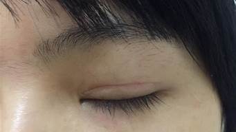 双眼皮手术拆线后红肿怎么办(双眼皮术后伤口发炎能拆线吗)