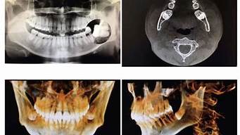 拍牙齿片是不是有辐射(拍牙片的辐射)