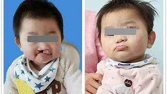 造成婴儿唇腭裂的原因是什么(什么原因导致唇腭裂宝宝)